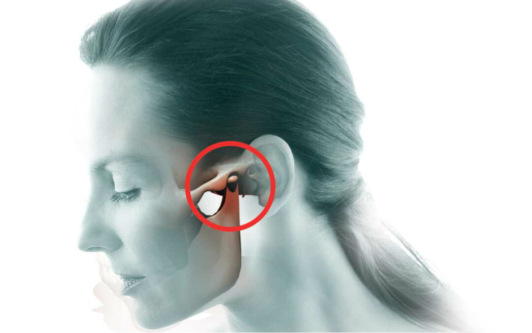 Illustration de l’articulation temporo-mandibulaire chez une femme, mettant en évidence la zone de douleur typique des troubles cranio-mandibulaires et leur lien avec la posture globale.