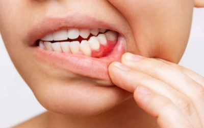 Maladie parodontale : pourquoi un simple détartrage ne suffit pas toujours